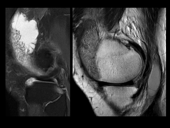 Figure 4 for case Lipoma Arborescens